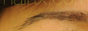 Eyebrow Hair Restoration