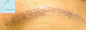 Eyebrow Hair Restoration