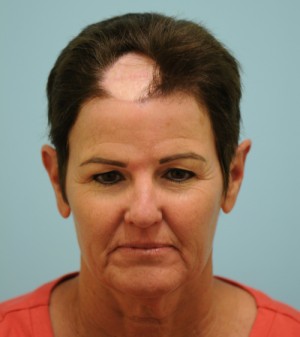 Corrective Hair Restoration