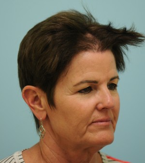 Corrective Hair Restoration