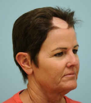 Corrective Hair Restoration