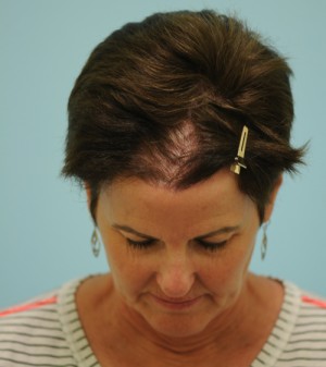 Corrective Hair Restoration