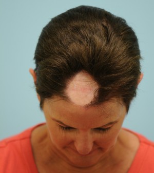 Corrective Hair Restoration