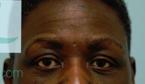 Eyebrow Hair Restoration
