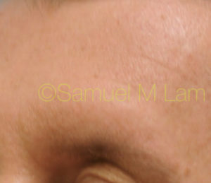 Eyebrow Hair Restoration
