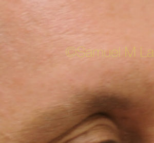 Eyebrow Hair Restoration