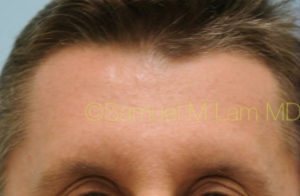 Eyebrow Hair Restoration
