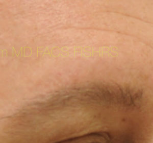 Eyebrow Hair Restoration