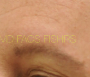 Eyebrow Hair Restoration