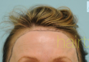 Female Hairline Lowering