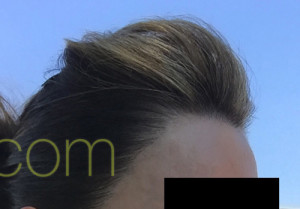 Female Hairline Lowering