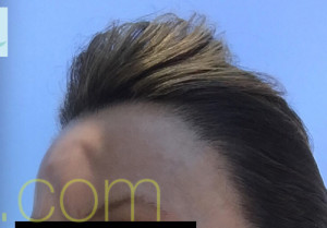 Female Hairline Lowering