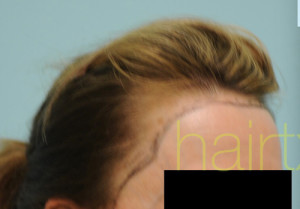 Female Hairline Lowering
