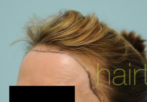 Female Hairline Lowering