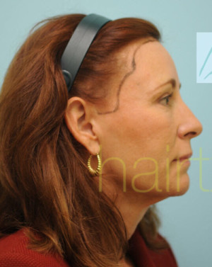 Female Hairline Lowering