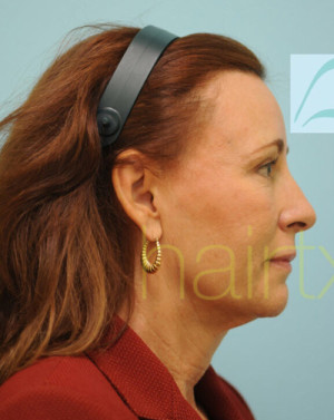 Female Hairline Lowering