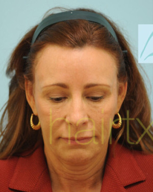 Female Hairline Lowering