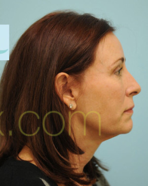 Female Hairline Lowering