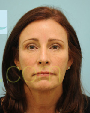 Female Hairline Lowering