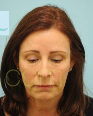 Female Hairline Lowering