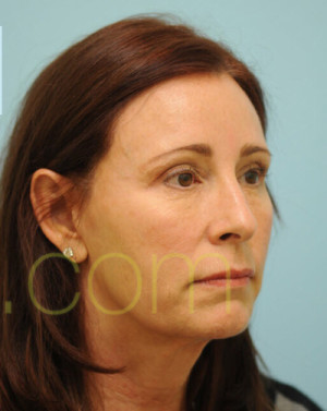 Female Hairline Lowering