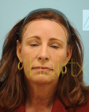 Female Hairline Lowering