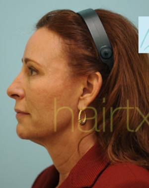 Female Hairline Lowering