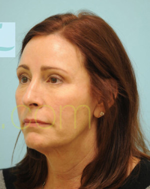 Female Hairline Lowering