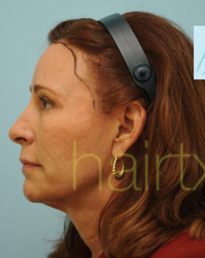 Female Hairline Lowering