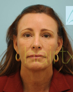 Female Hairline Lowering