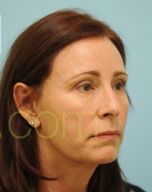 Female Hairline Lowering