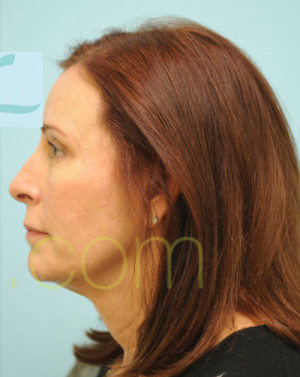 Female Hairline Lowering