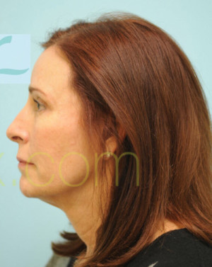 Female Hairline Lowering