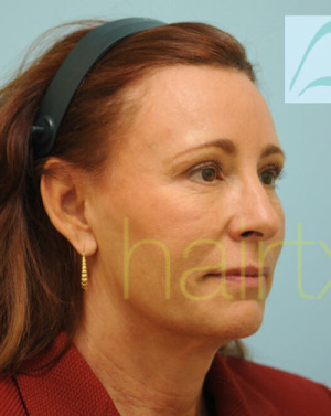 Female Hairline Lowering