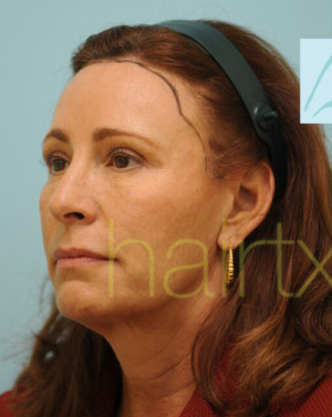 Female Hairline Lowering