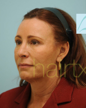 Female Hairline Lowering