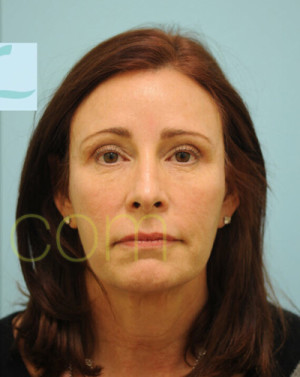 Female Hairline Lowering