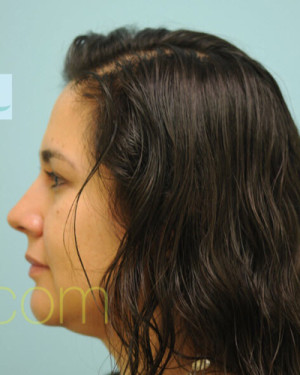 Female Hair Transplant