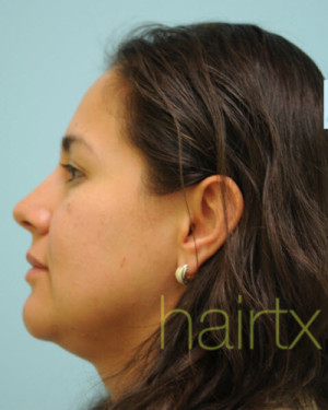 Female Hair Transplant