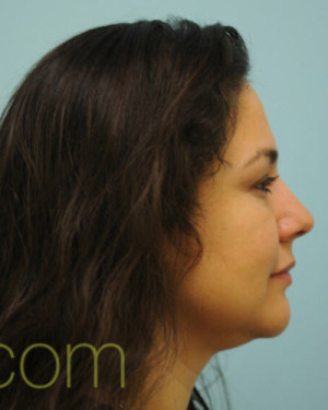 Female Hair Transplant