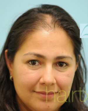 Female Hair Transplant