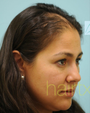 Female Hair Transplant