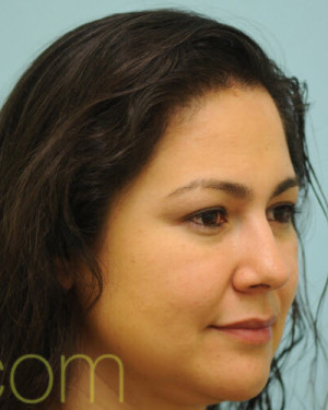 Female Hair Transplant