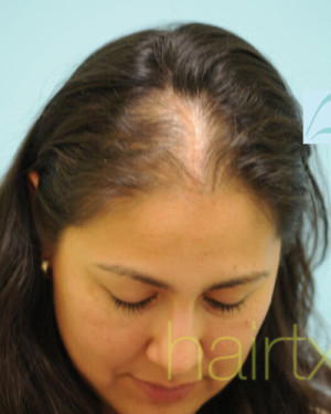 Female Hair Transplant
