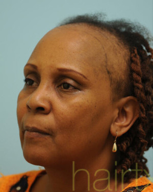 African Hair Transplant