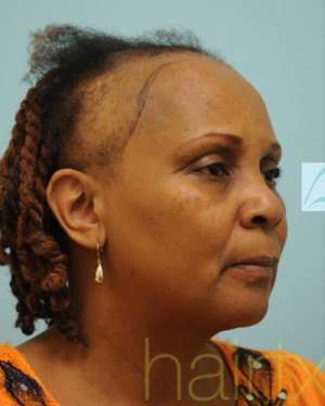 African Hair Transplant