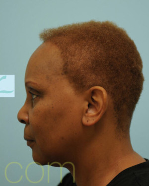 African Hair Transplant