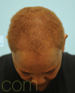 African Hair Transplant