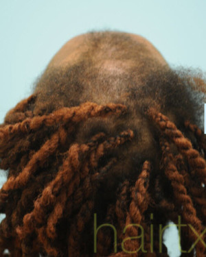 African Hair Transplant