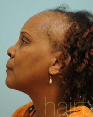 African Hair Transplant